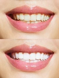 dental before and after 1