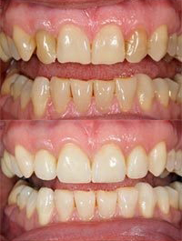 dental before and after 4