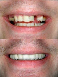 dental before and after 5