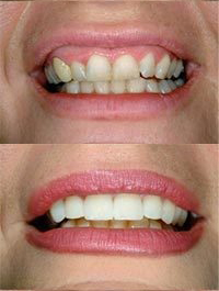 dental before and after 6