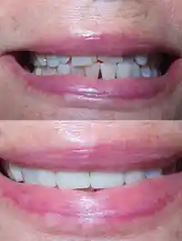 Close up picture of a BDC Patient Before and After treatment