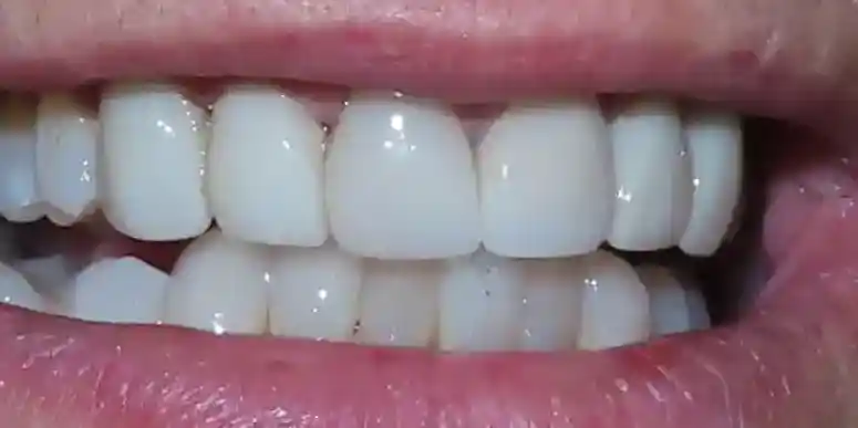 BDC Patient After Photo