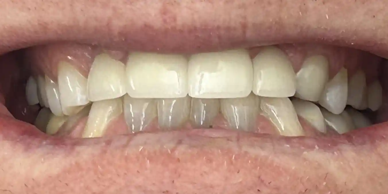 BDC Patient After Photo