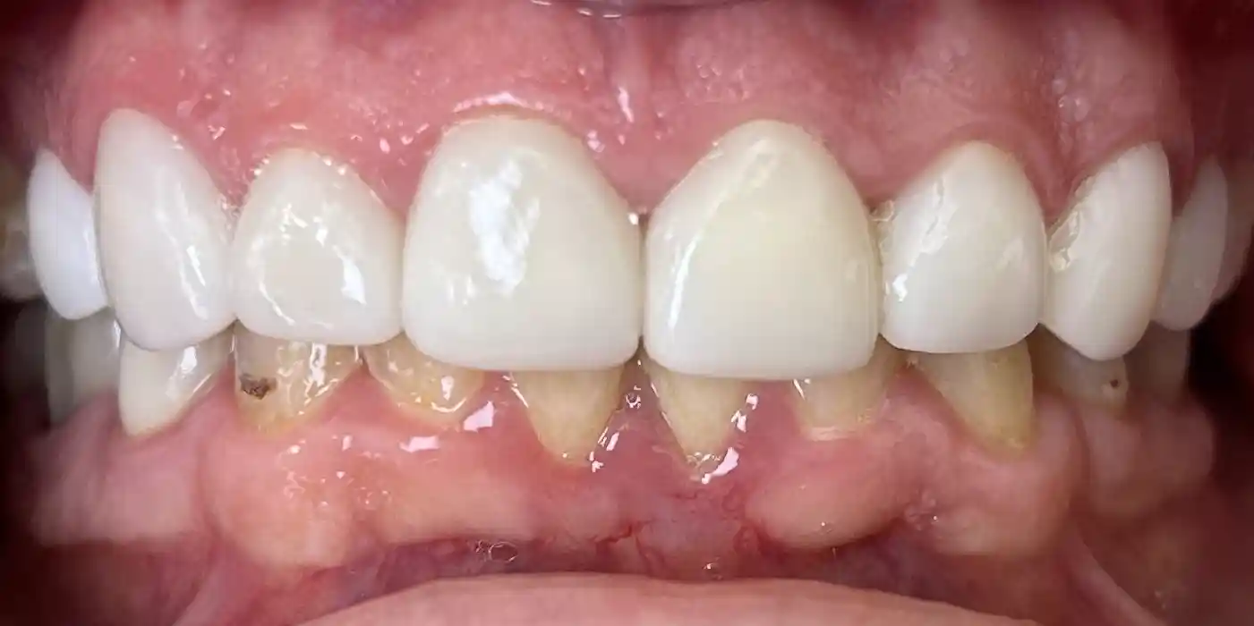 Dr. Nolan Veneers Patient After Photo