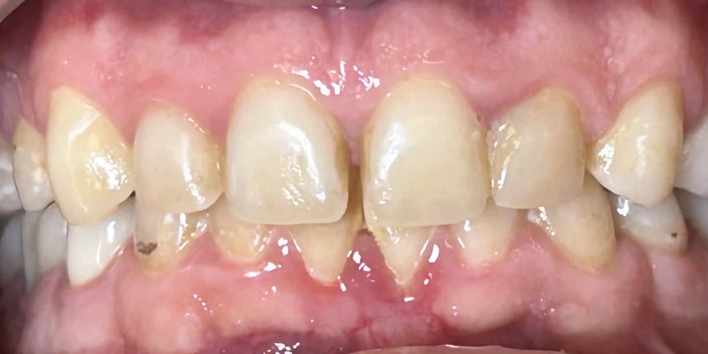 Dr. Nolan Veneers Patient Before Photo